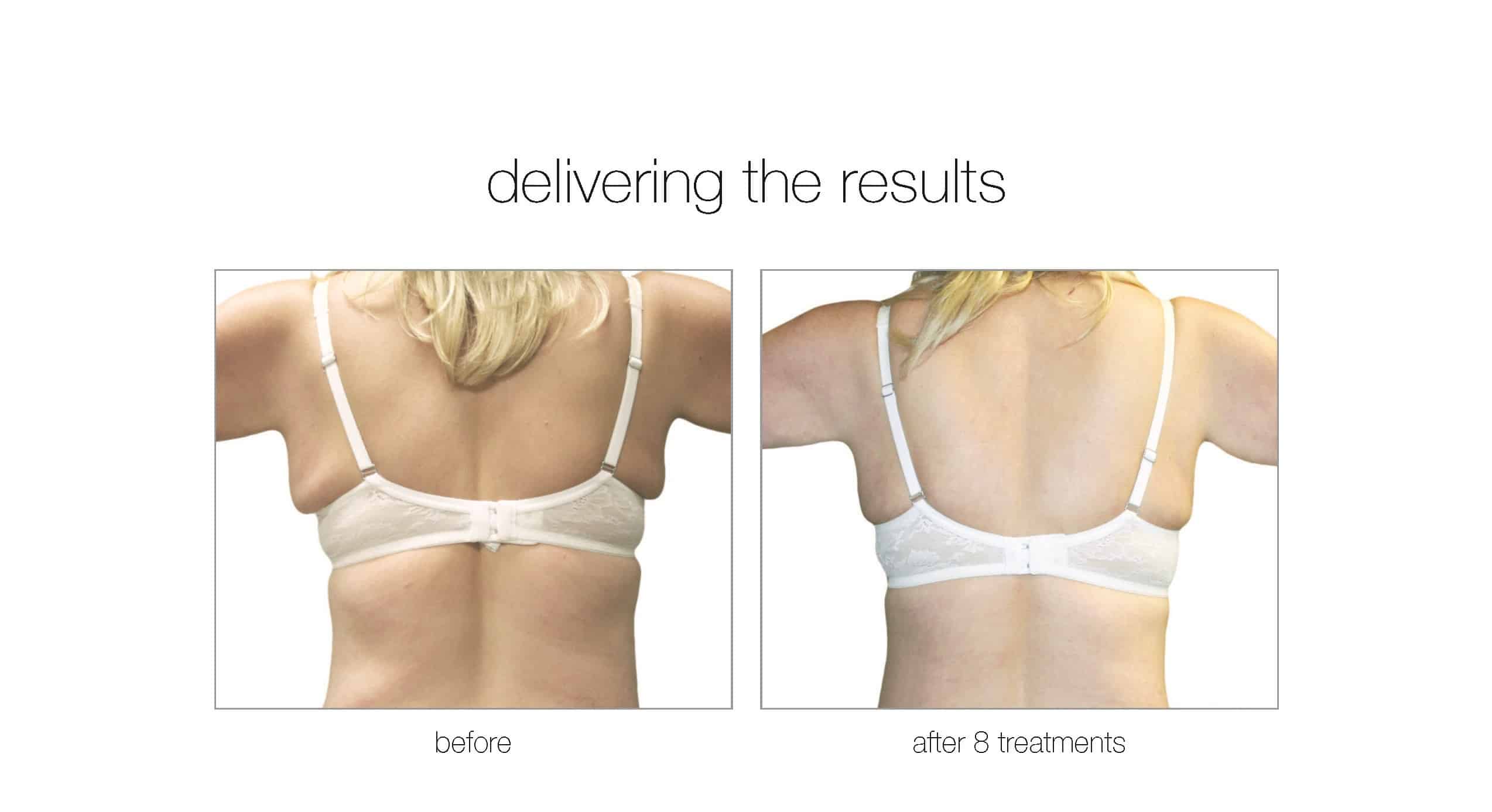RF Body Contouring North Vancouver