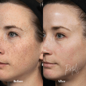 acne reduction 1 300x300 1