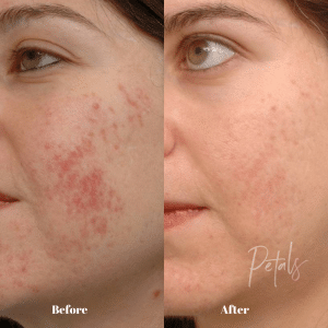 acne reduction 300x300 1
