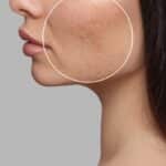 Acne Scars