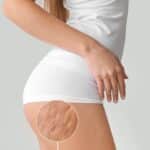 Cellulite