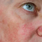 Vascular Lesions (Redness)
