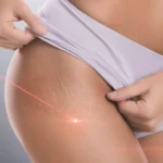 Stretch Marks