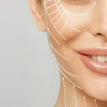 Smile Lines