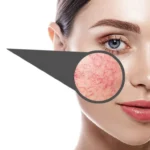 Rosacea