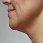 Jawline: Contouring, Masseters
