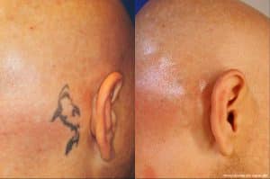 laser tattoo removal before and after 300x199 2