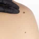 Pigmented Lesions (Brown Spots)