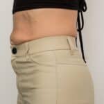 Sagging Skin