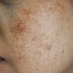 Sun Damaged Skin