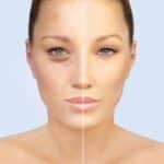 Facial Volume Loss